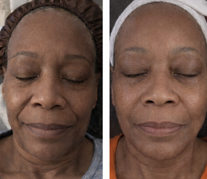 Collagen Peptide Lifting Ampoule